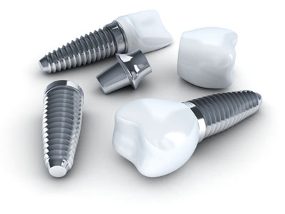 All On Four Procedure &#    ; What You Need To Know About Teeth Replacement