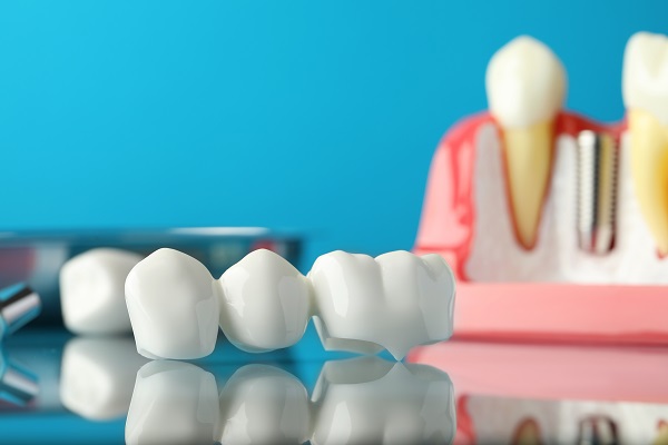 Ask A Dentist: How Do I Prepare For A Dental Bridges Procedure?