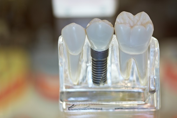 Replace A Missing Tooth With A Dental Implant