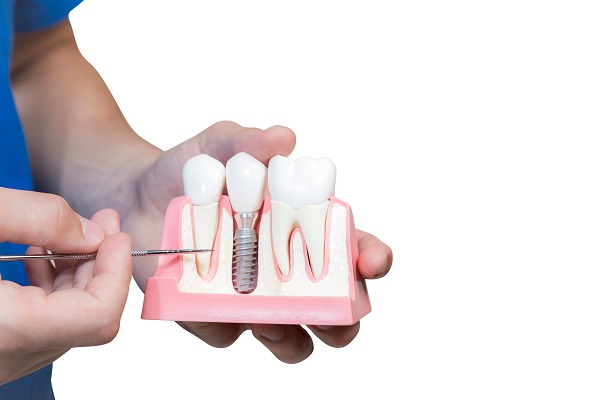 How An Experienced Implant Dentist Can Improve Your Smile