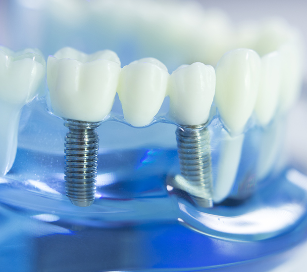 Silver Spring Dental Implants