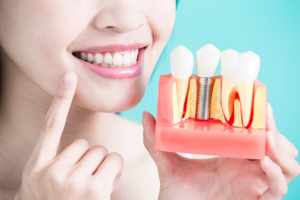 Ask An Implant Dentist About Natural Vs  Artificial Teeth