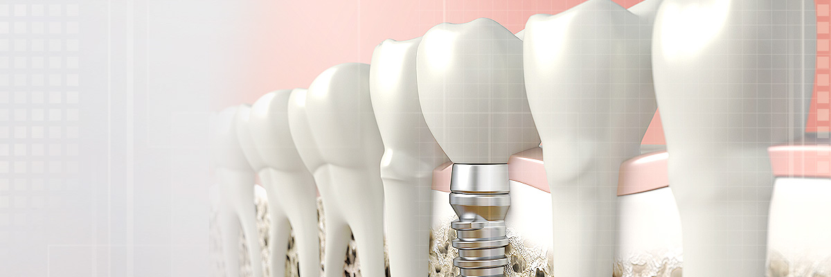 Silver Spring Implant Dentist