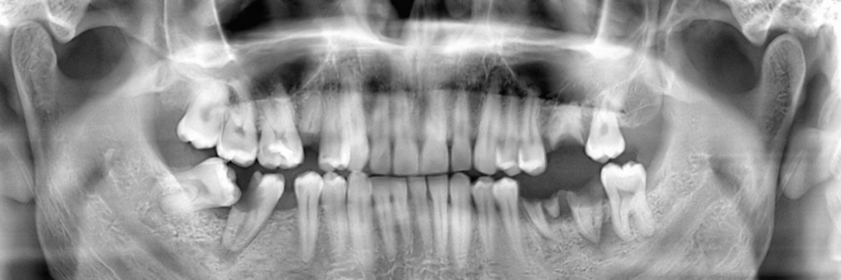 Silver Spring Options for Replacing Missing Teeth