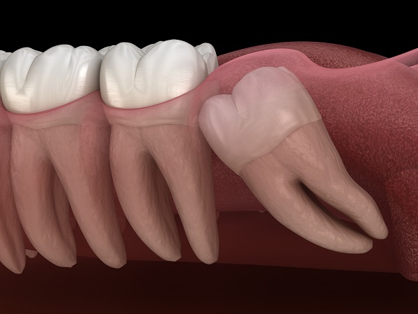wisdom tooth extraction Silver Spring, MD